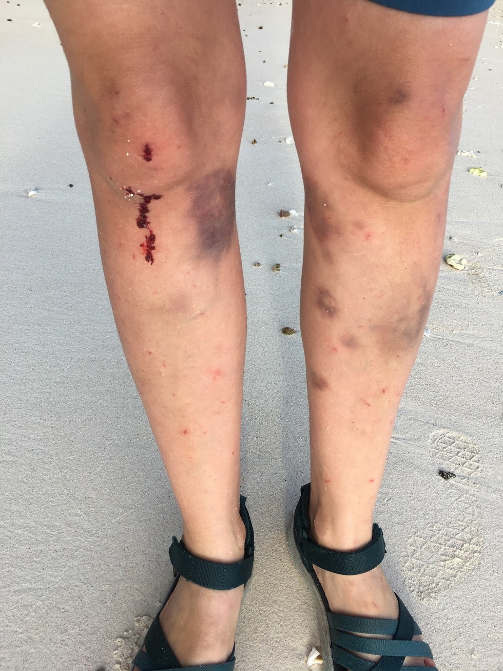 An expeditioner's legs after crossing the island
